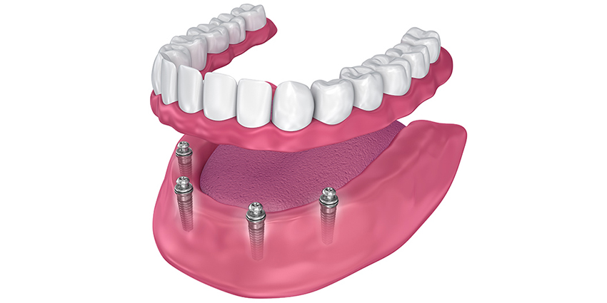 All On 4 Dental Implants Cost