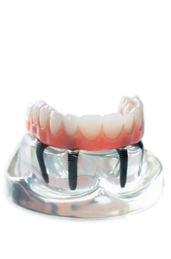 All On 4 Dental Implants Cost Mexico Dental Equipment