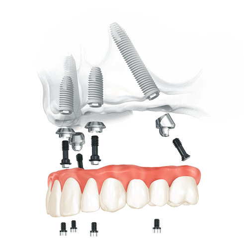 All On 4 Dental Implants Cost Mexico