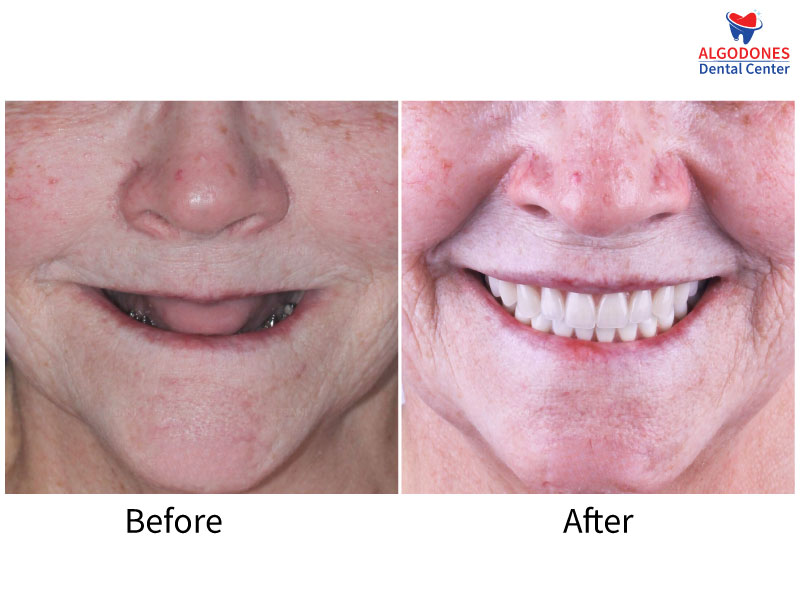 All On 4 Dental Implants Cost Mexico