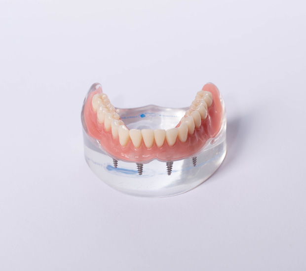 All On 4 Dental Implants Price