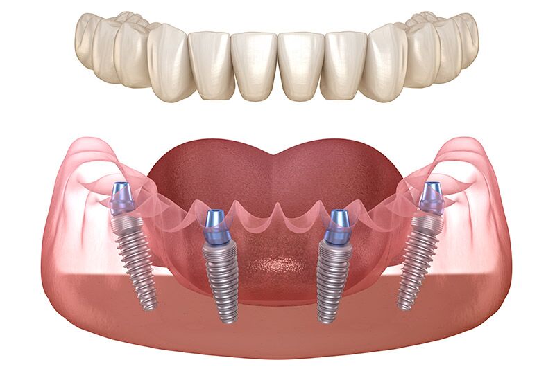 All On 4 Dental Implants Prices
