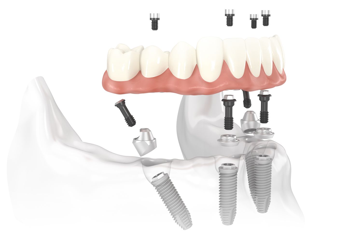 All On 4 Dental Implants Prices