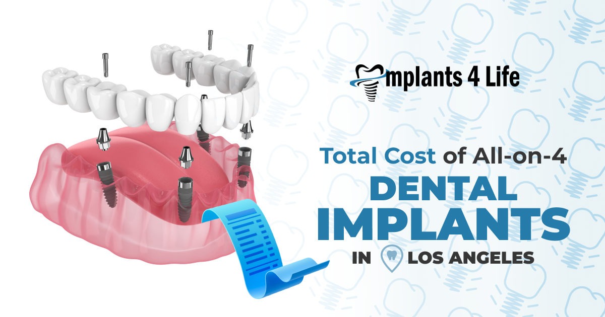 All On Four Dental Implants Cost
