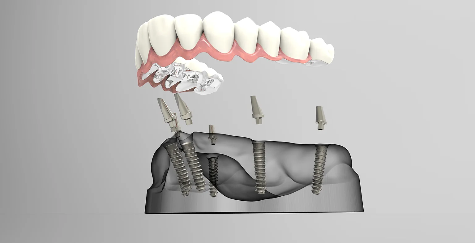 Average Cost Of All On 4 Dental Implants