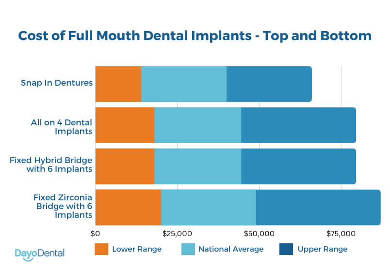 Average Cost Of Whole Mouth Dental Implants
