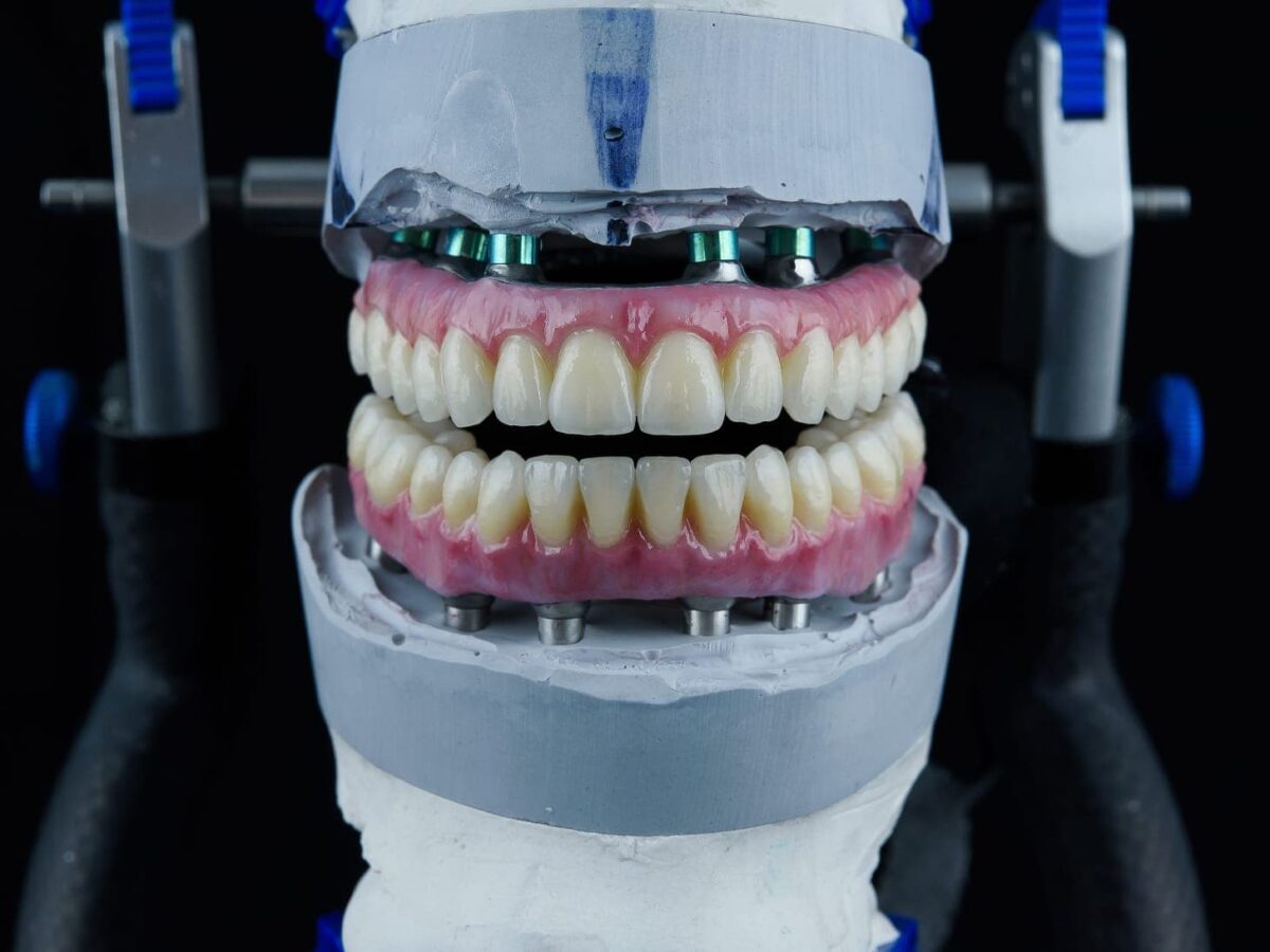 Best Dental Implants In Turkey Cost