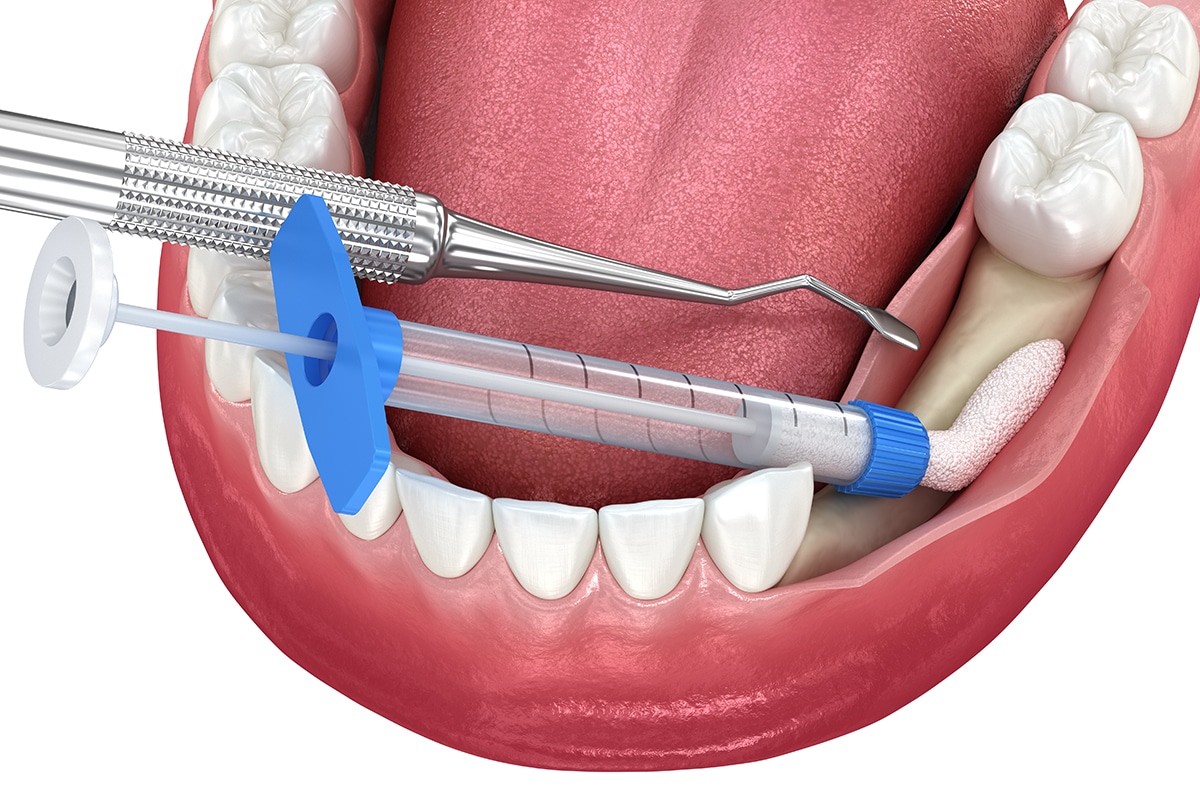 Bone Grafting For Dental Implants Cost