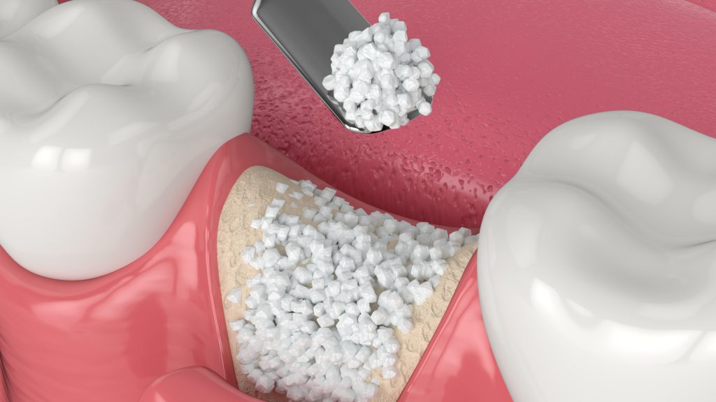Cost Of 2 Dental Implants With Bone Grafting
