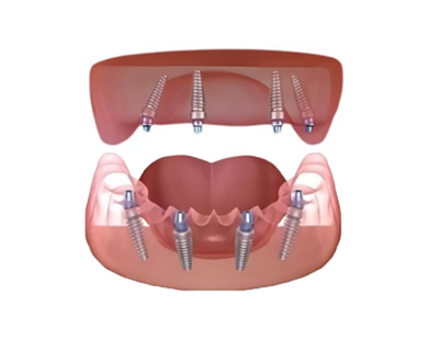 Cost Of 4 On 1 Dental Implants In Mexico Dental Equipment