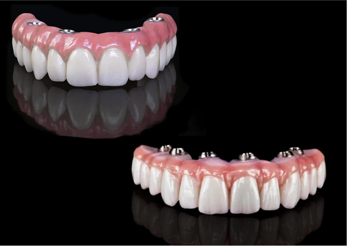 Cost Of 4 On 1 Dental Implants In Mexico