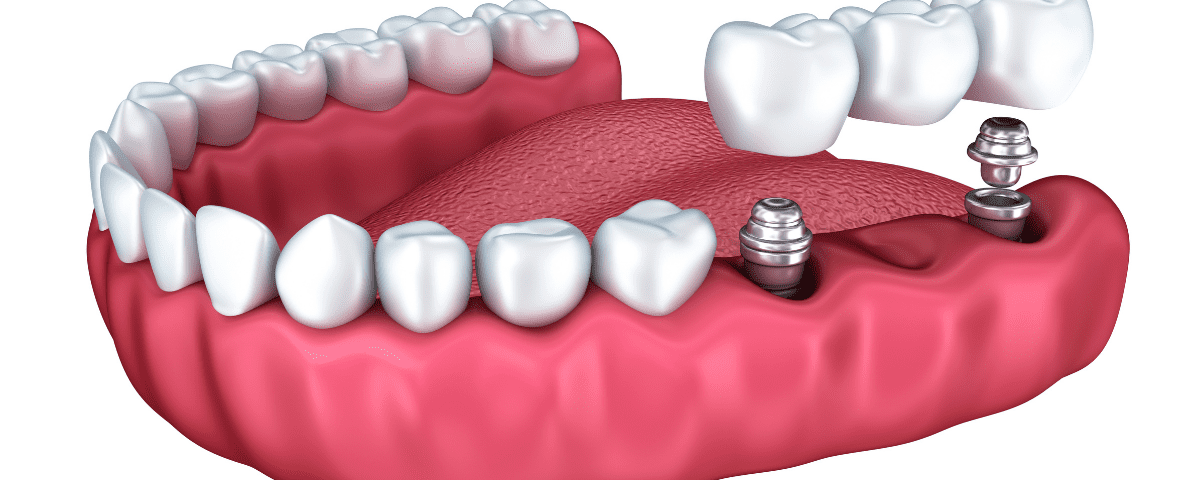 Cost Of Dental Implants In Fresno