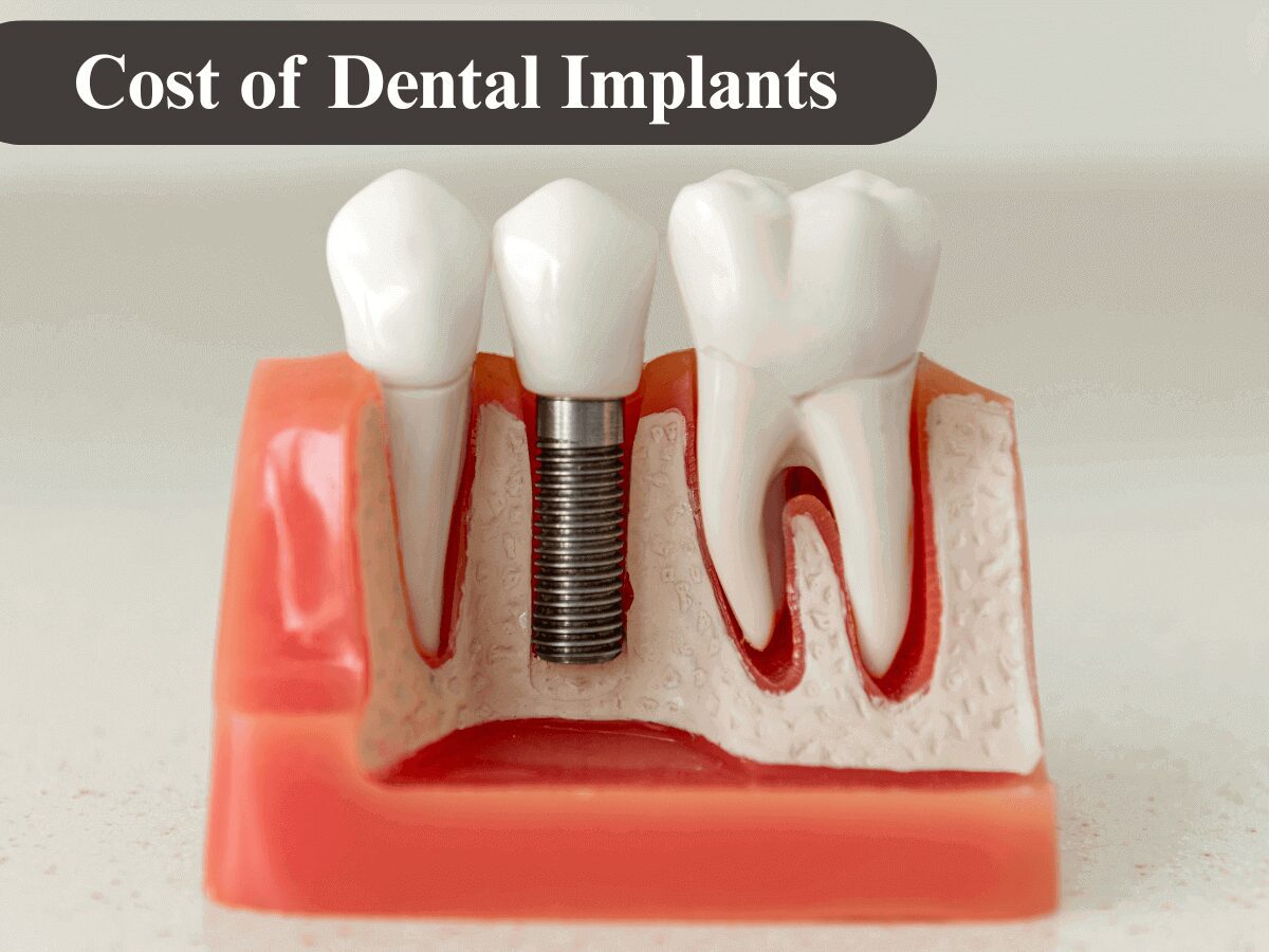 Cost Of Dental Implants In Fresno