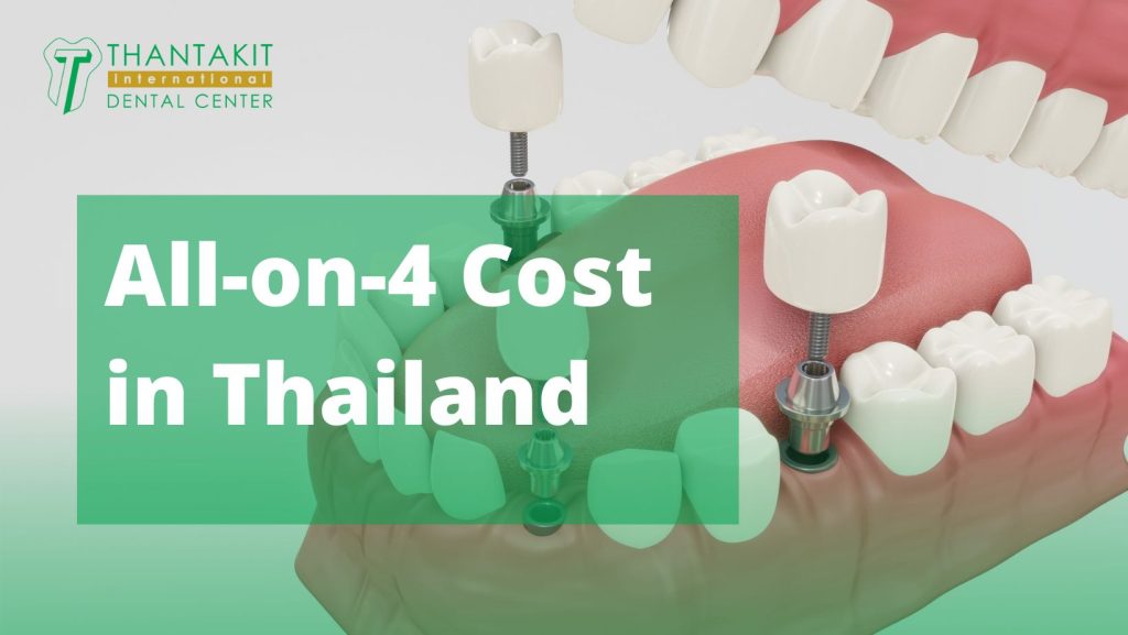Cost Of Dental Implants Thailand Dental Equipment