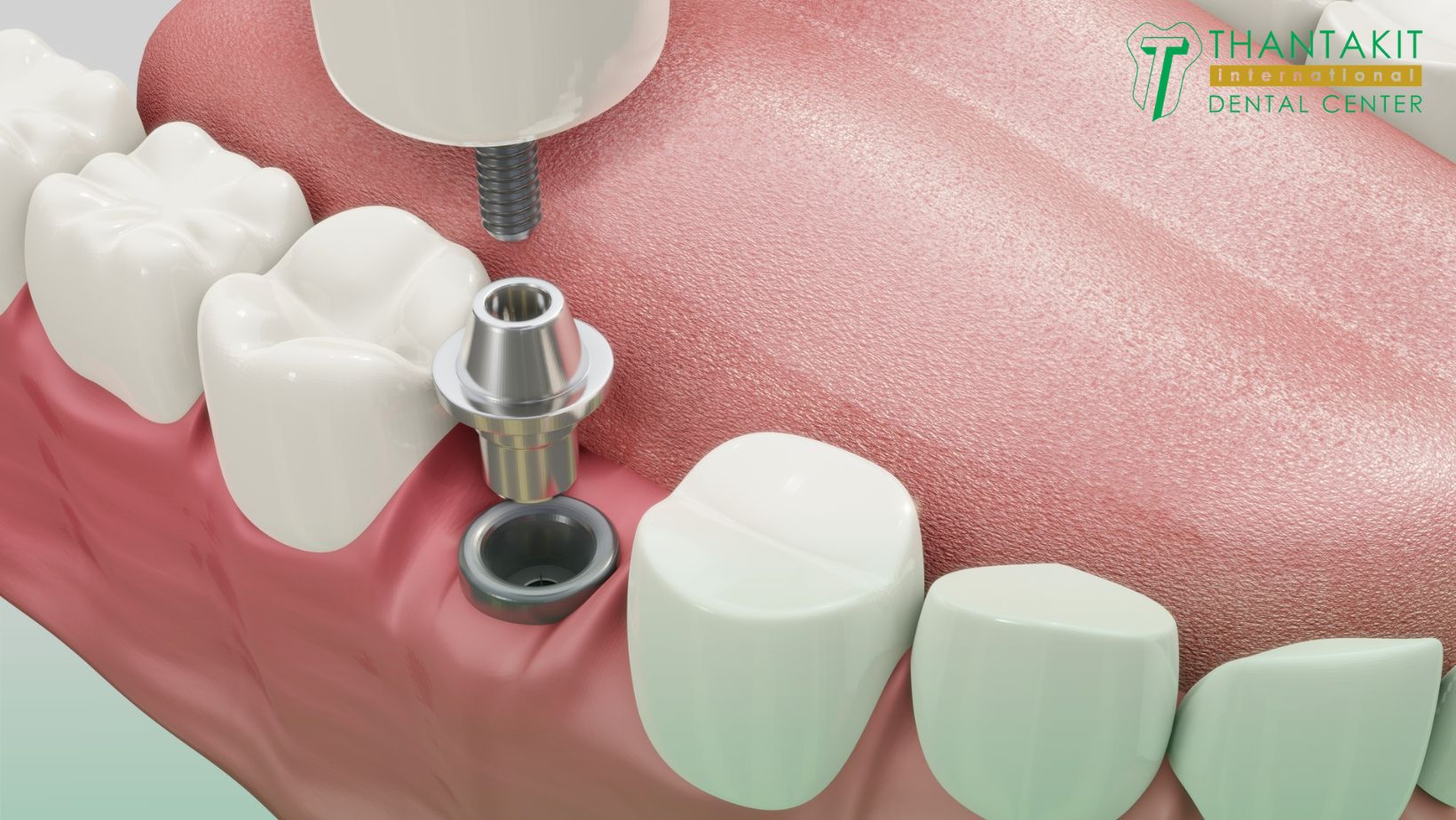 Cost Of Dental Implants Thailand