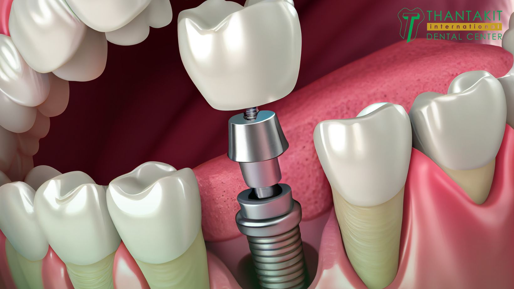 Cost Of Dental Implants Thailand