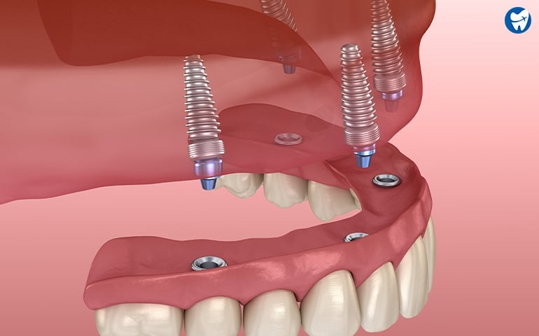 Cost Of Dental Implants Thailand