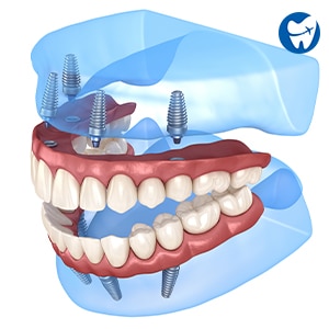 Costa Rica Dental Implants Price
