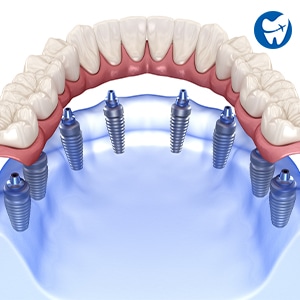 Costa Rica Dental Implants Price