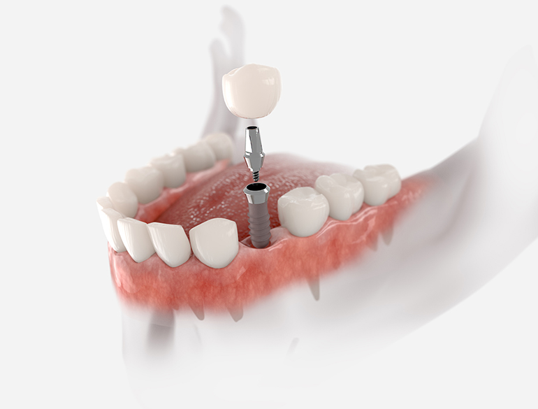 Dental Implant Cost For One Tooth Dental Equipment