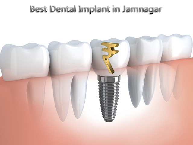 Dental Implant Cost In India