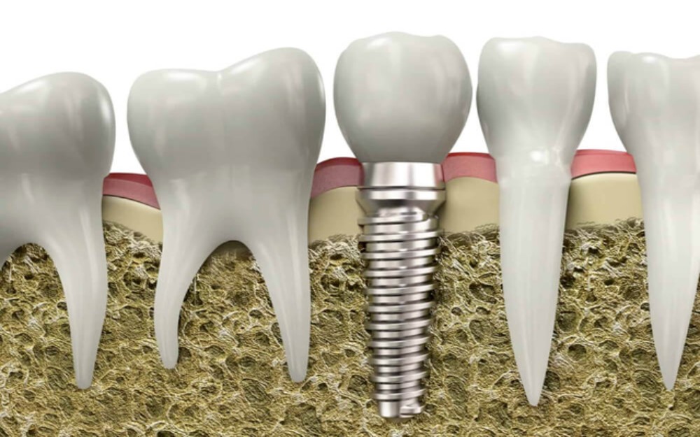 Dental Implant Cost Los Angeles
