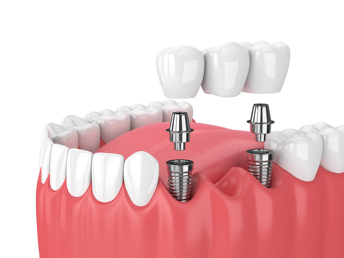 Dental Implants And Bridges Cost