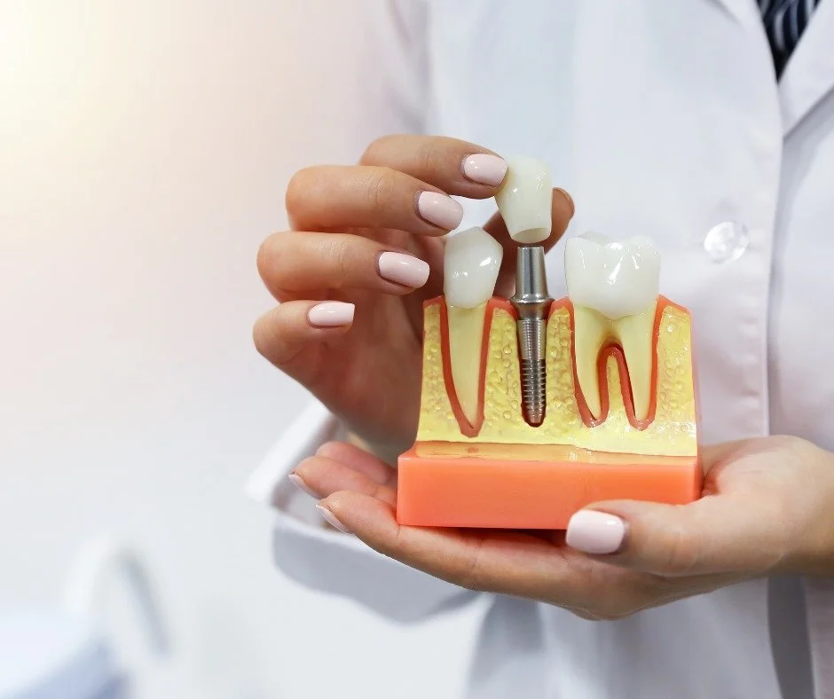 Dental Implants Cost Canada