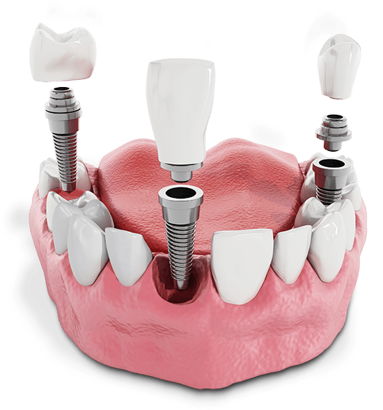 Dental Implants Dallas Cost Dental Equipment