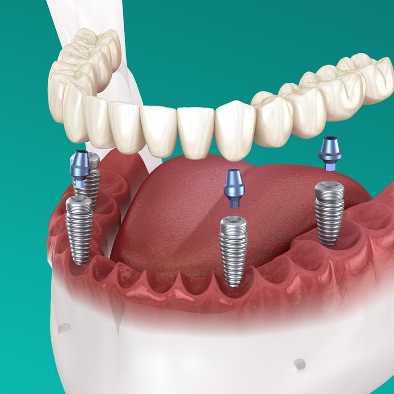 Dental Implants Dallas Cost