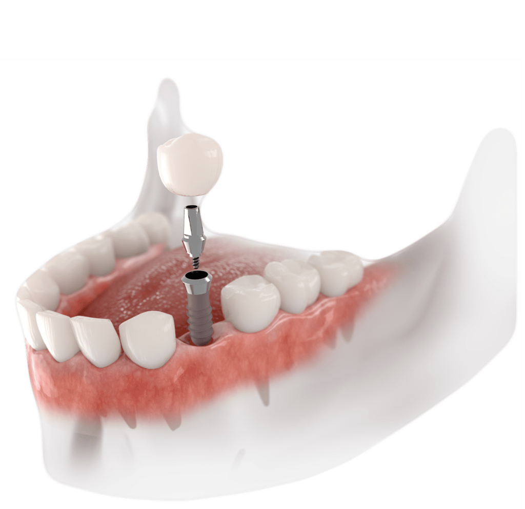 Dental Implants In Turkey Price