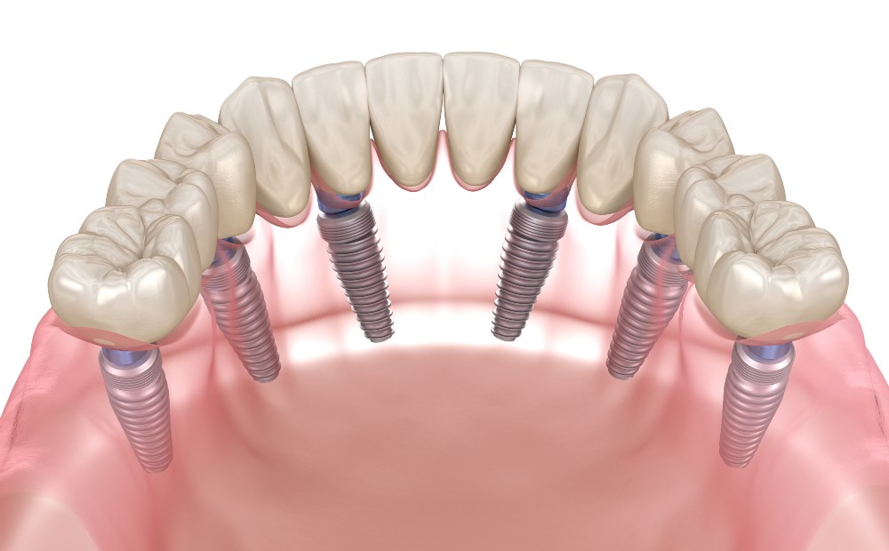 Dental Implants In Turkey Price
