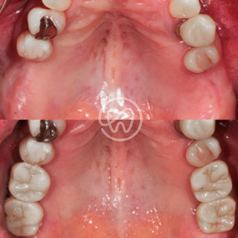 Dental Implants Tijuana Cost