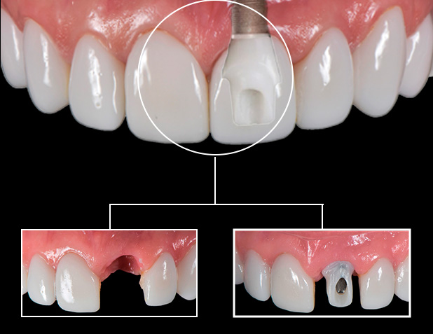 Dental Implants Tijuana Cost