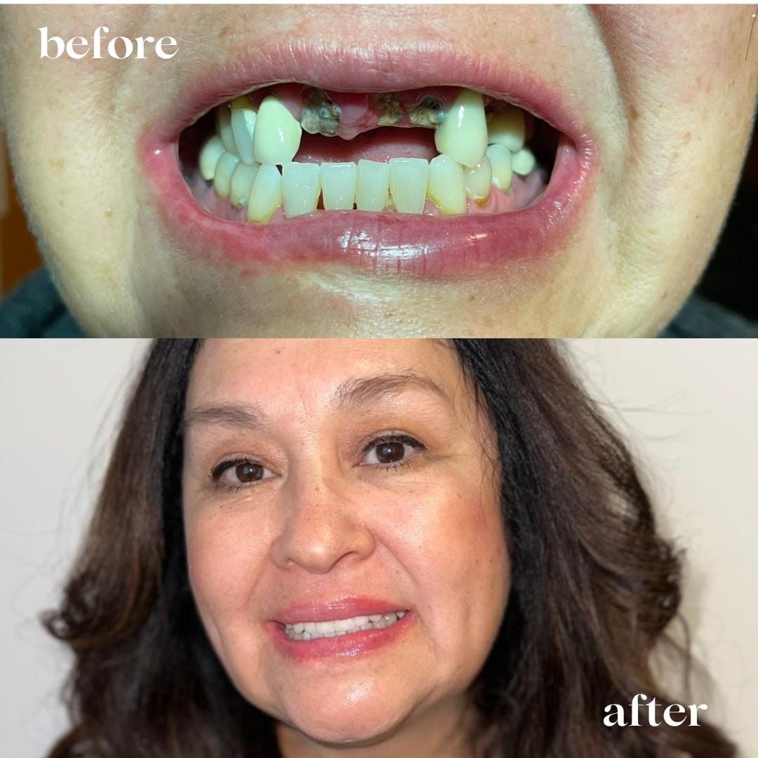 Dental Implants Tijuana Cost