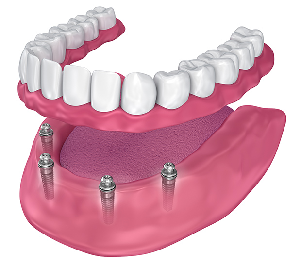 Four In One Dental Implants Cost