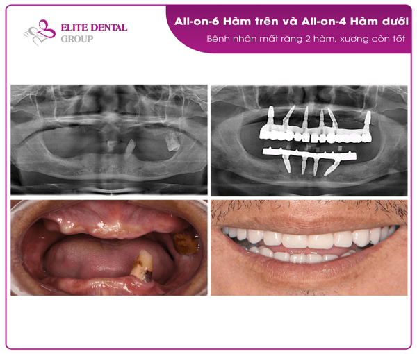 Full Mouth Dental Implants Cost Usa