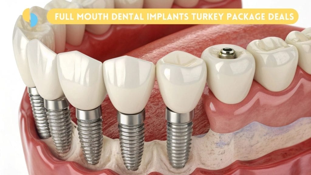 Full Mouth Dental Implants Turkey Price