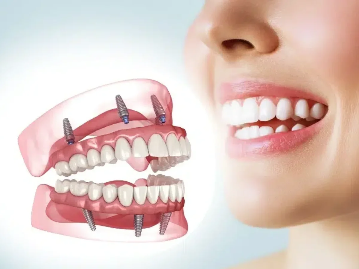 Full Mouth Dental Implants Turkey Price