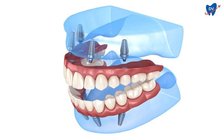 Full Mouth Dental Implants Turkey Price