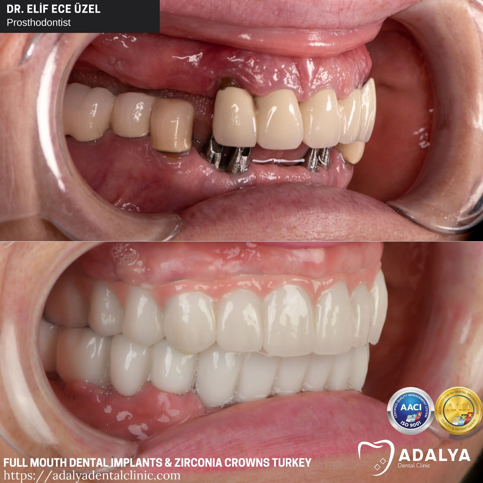 Full Mouth Dental Implants Turkey Price