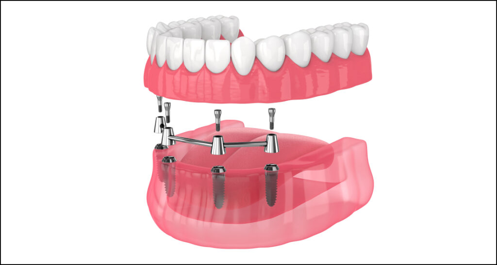 Full Upper Dental Implants Cost