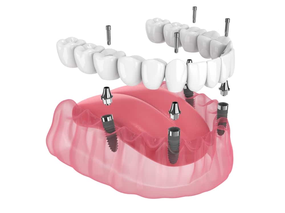 How Much Do All On 4 Dental Implants Cost