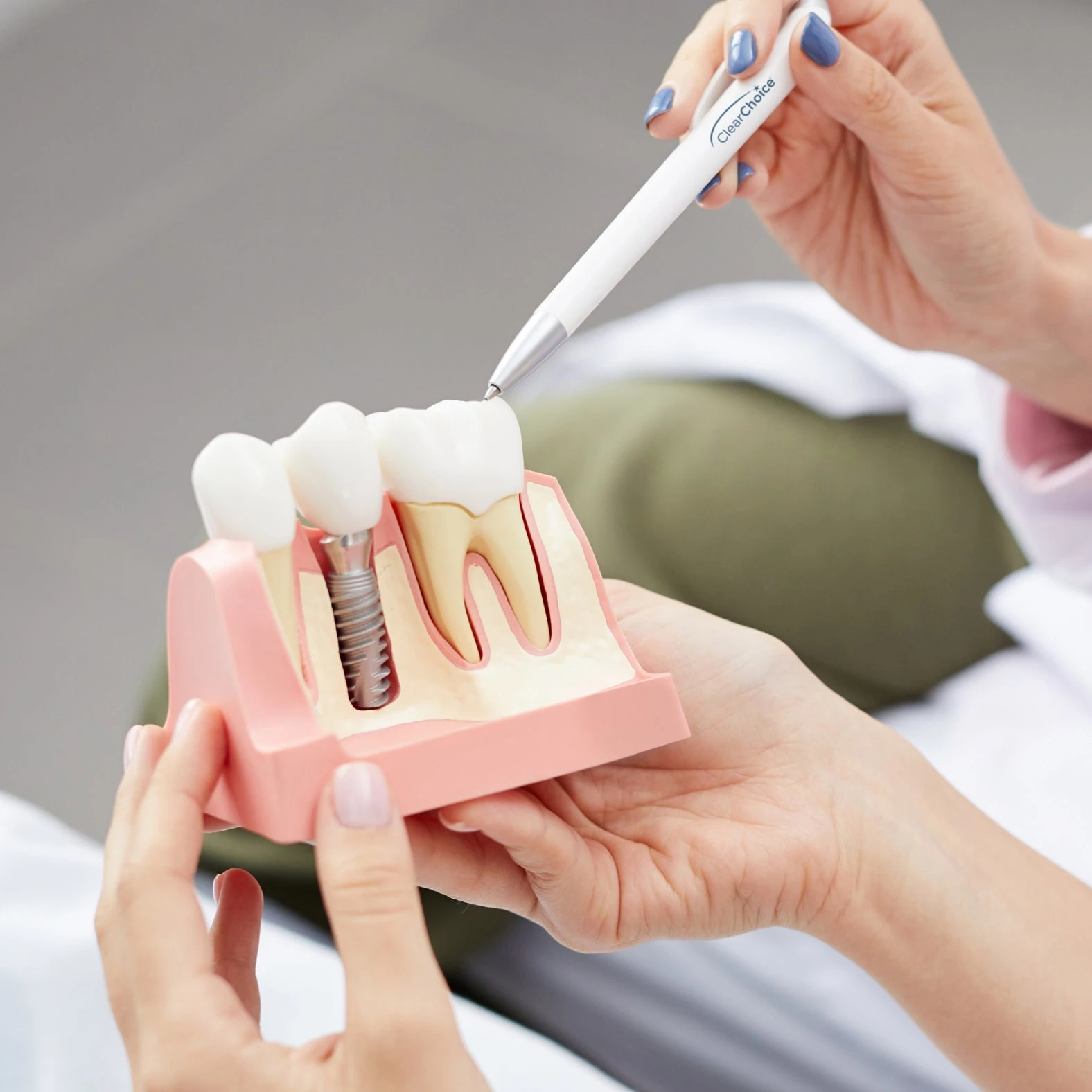 How Much Do Clear Choice Dental Implants Cost