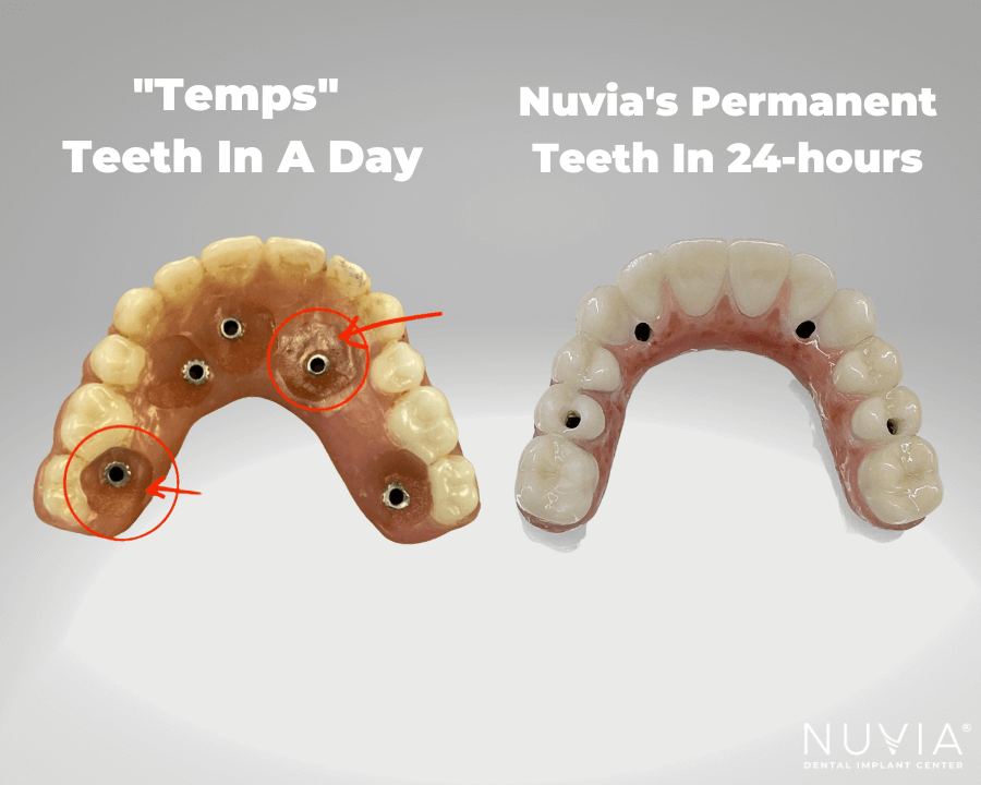 How Much Does Nuvia Dental Implants Cost
