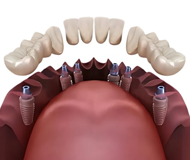 Is It Safe To Get Dental Implants In Costa Rica