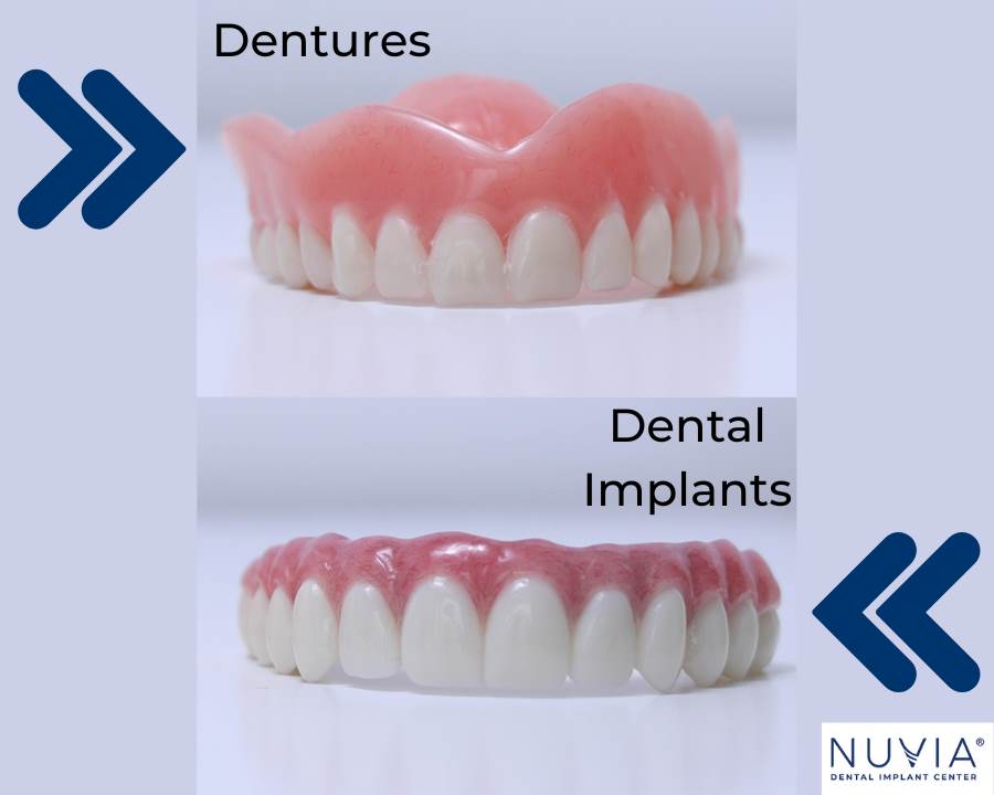 Nuvia Dental Implant Cost