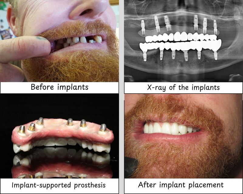 Tijuana Dental Implants Prices Dental Equipment