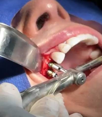 Tijuana Dental Implants Prices