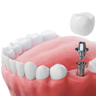 Tijuana Dental Implants Prices
